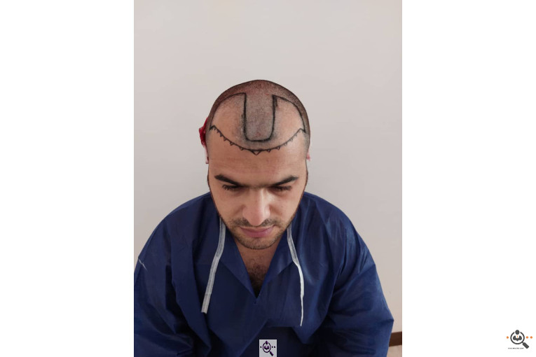 کاشت مو فرشته غلامی در تهران و ایلام09123267841