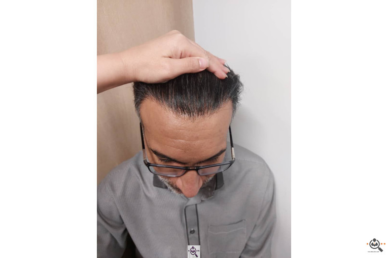 کاشت مو فرشته غلامی در تهران و ایلام09123267841