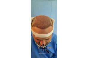 کاشت مو شقاقی در مشهد