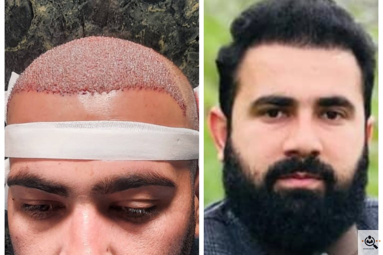 کاشت مو شقاقی در مشهد