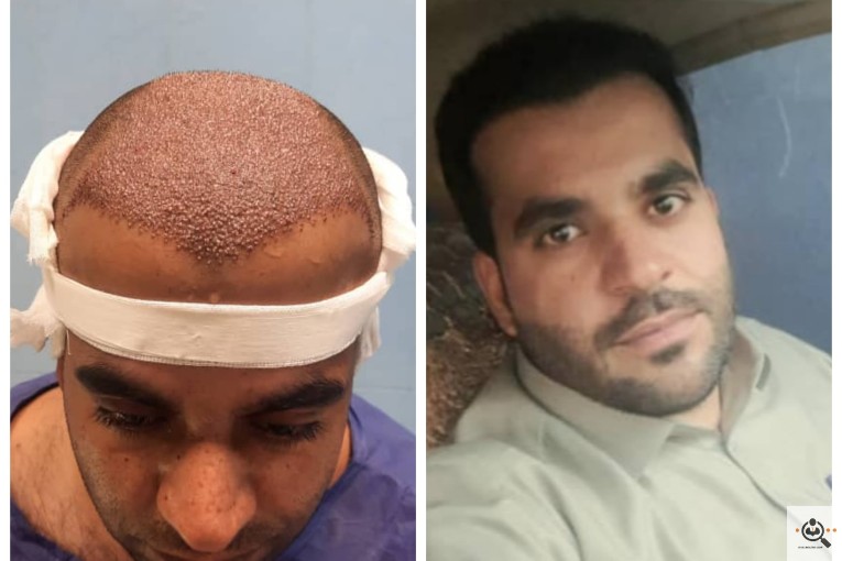 کاشت مو شقاقی در مشهد