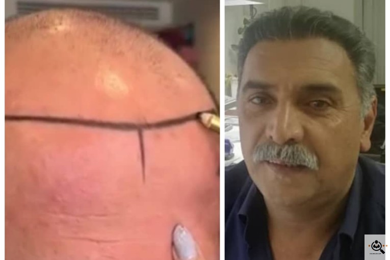 کاشت مو شقاقی در مشهد