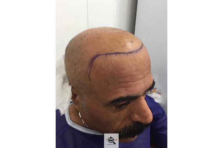 خدمات کاشت مو و ابرو مرضیه دلیان در اهواز